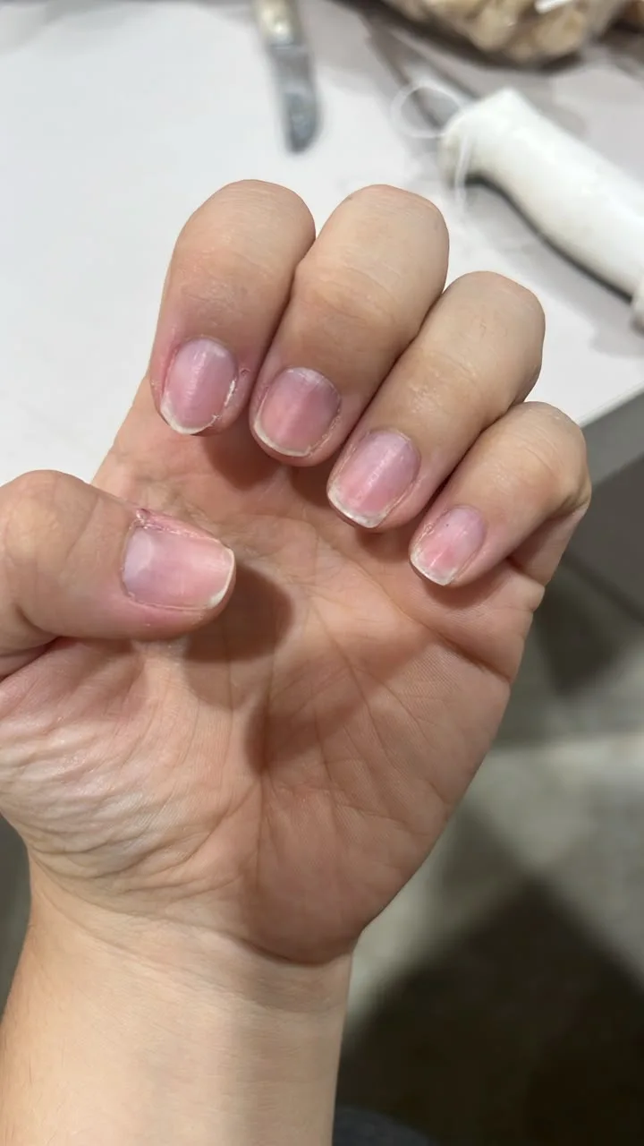 Unhas naturais curtas e machucadas, antes do alongamento